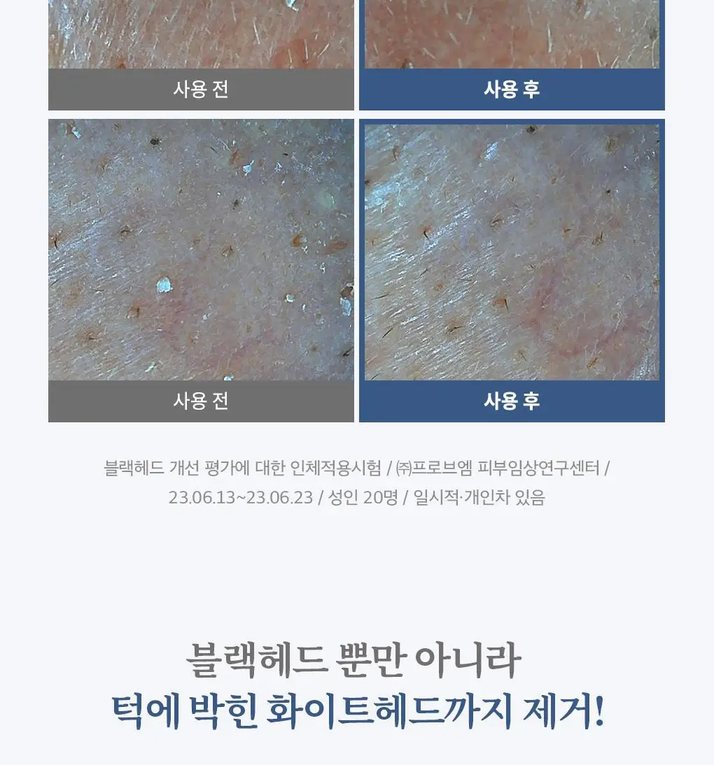 [블랙헤드관리/김다혜PICK] 비프로젝트 바이 블랙헤드 멜팅 리무버 30ml 상세페이지 40